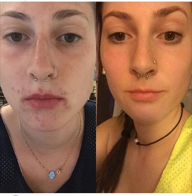 Coffee face mask before and after